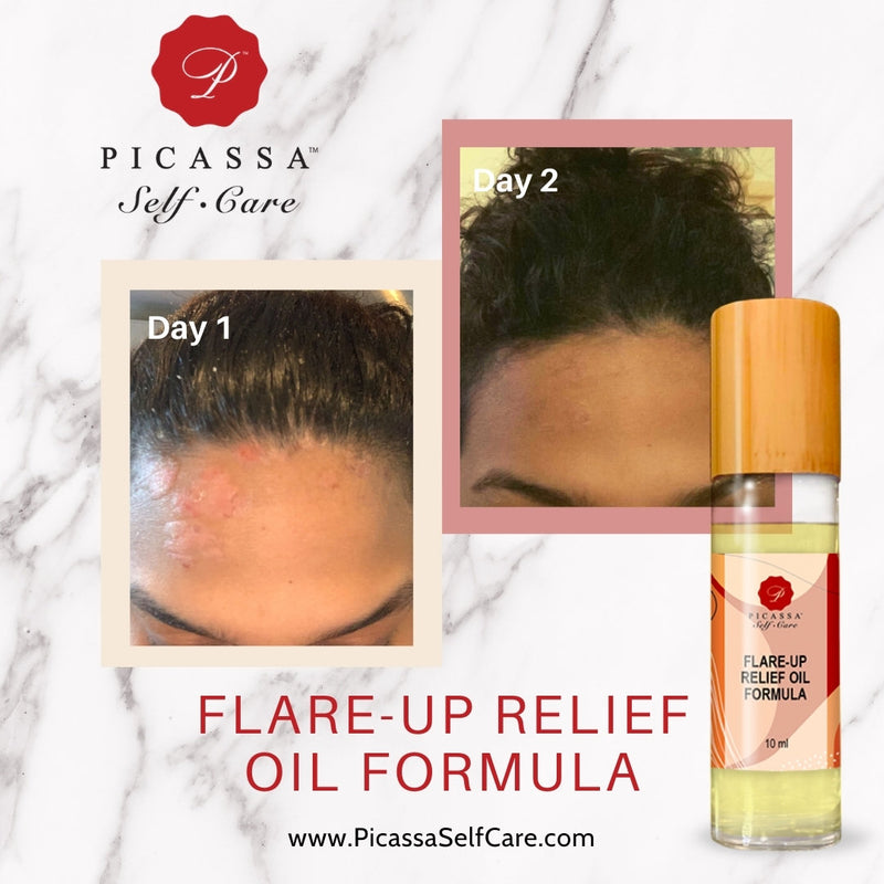 Flare-up Relief Oil, Organic Psoriasis Treatment, Eczema, Reduces Redness,Inflammation, Skin Care, Dry Skin, Eczema Oil, Psoriasis Oil